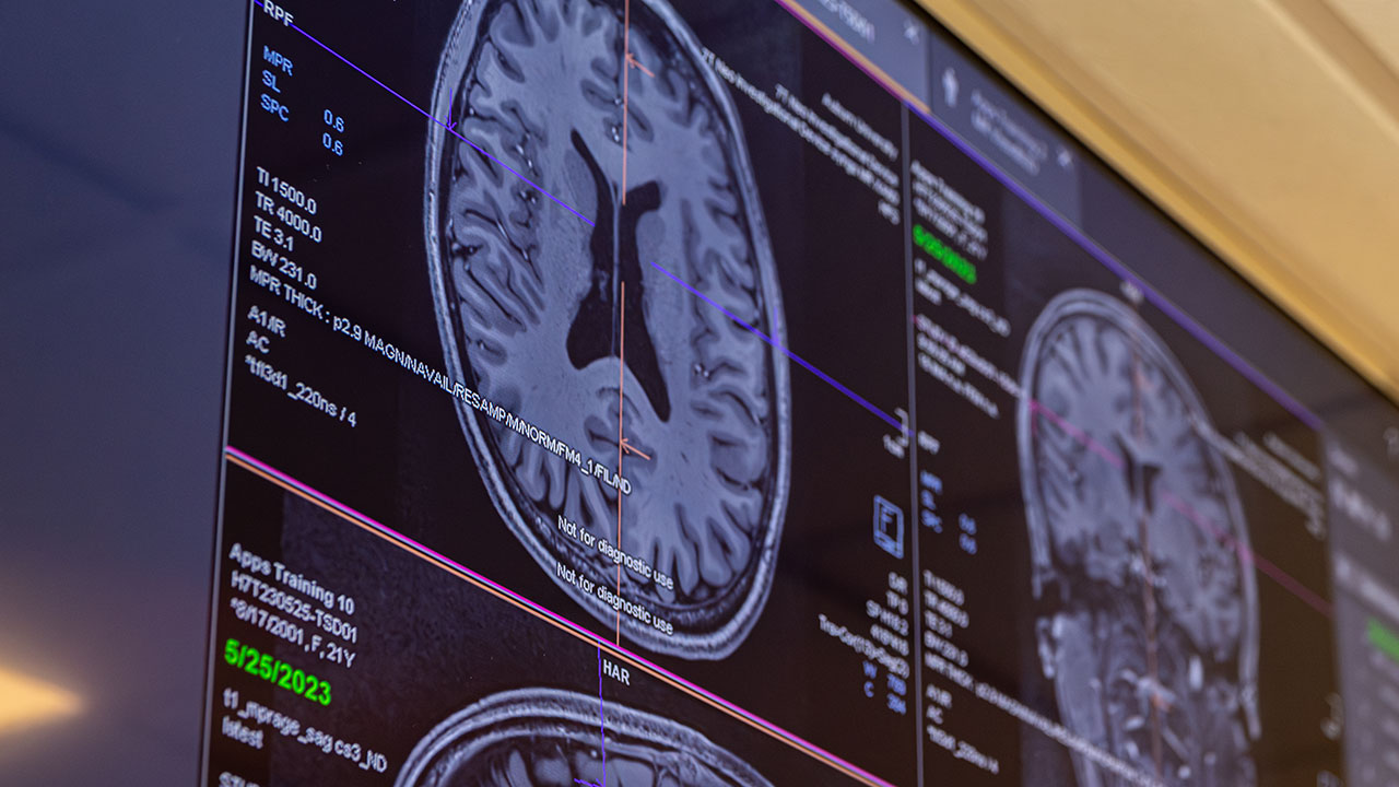 Adil Bashir will examine brain MRI of 120 subjects with schizophrenia spectrum disorders between the ages of 35-65 years and compare those images to healthy individuals.